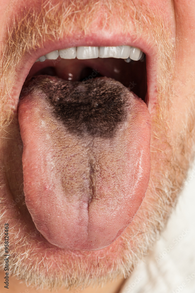 Obraz premium Black hairy tongue closeup