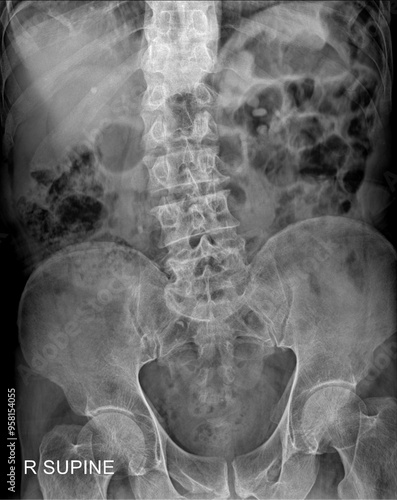 Supine Abdominal Radiography for Diagnostic Purposes photo