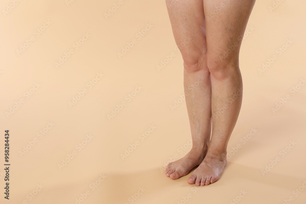 Woman with varicose veins on beige background, closeup. Space for text Woman with varicose veins on beige background, closeup. Space for text