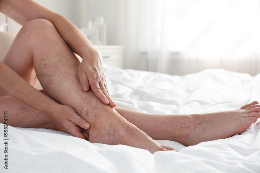 Woman suffering from varicose veins on bed indoors, closeup Woman suffering from varicose veins on bed indoors, closeup