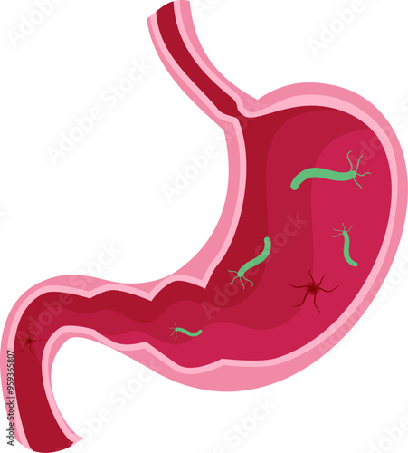 Stomach disease Illustration. Helicobacter pylori disease