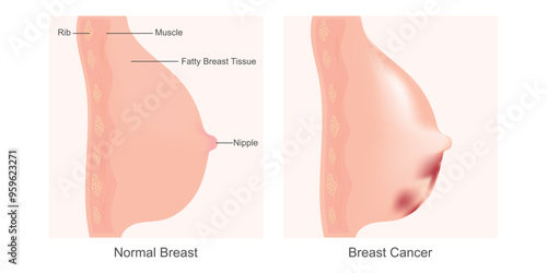 Breast cancer is a disease.