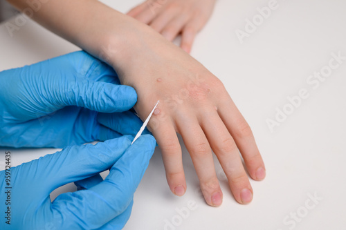 Child undergoing treatment for warts. Doctor removing wart from hand with applicator with medical solution, close-up. Papillomavirus, HPV. Pediatric dermatology, viral skin diseases photo