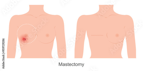 Mastectomy is a way of treating breast cancer.