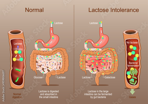Lactose Intolerance. Cross section of a human intestine with Lactase, Glucose, Galactose