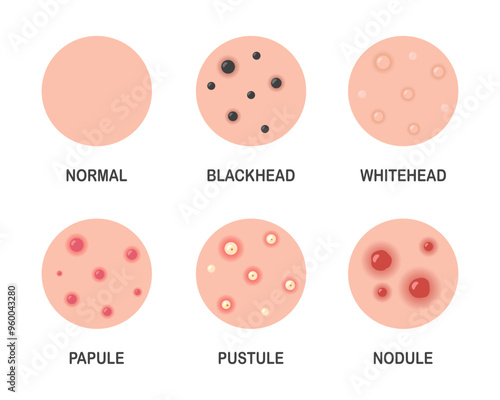 Acne types, skin pimples, blackheads. Dermatology poster problems acne.