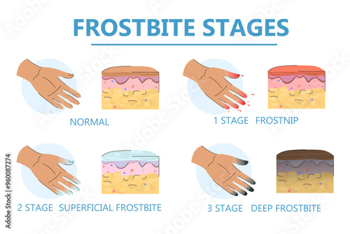 Frostbite stages infographic vector isolated. Damaged fingers. Signs of hypothermia. Concept of health care, symptoms of frostbite.