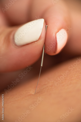 Acupuncture for reducing fluid retention photo