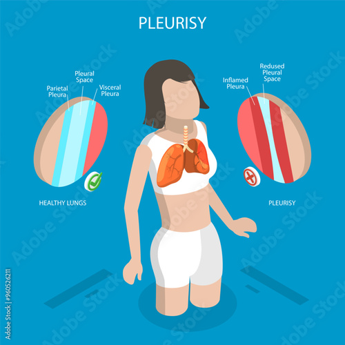 3D Isometric Flat Vector Illustration of Pleurisy Or Pleuritis Disease, Medical Overview of Lung Inflammation