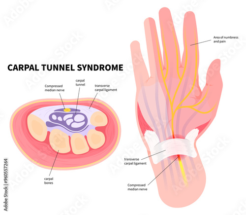Hand pain and the Quervain's tenosynovitis disease with Carpal tunnel syndrome in medical