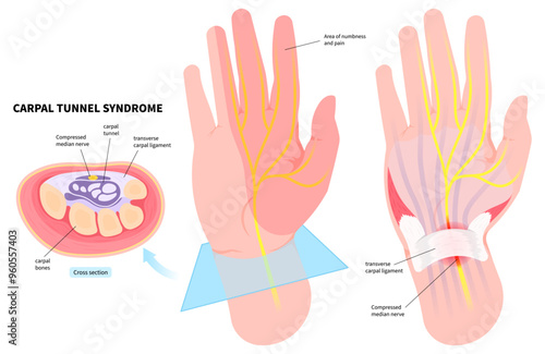 Hand pain numbness associated with the Quervain's tenosynovitis disease and Carpal tunnel syndrome in medical