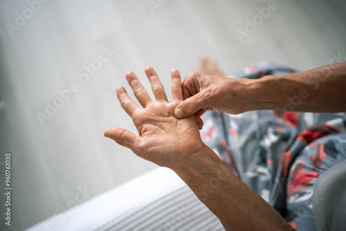 Foto Dupuytren contracture, protuberance on palm
