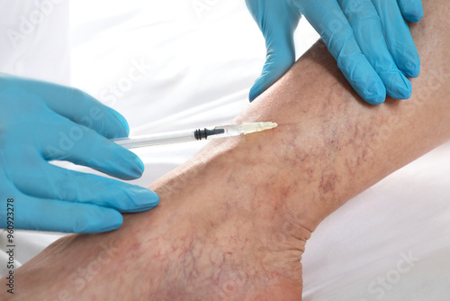 Varicose veins treatment. Doctor giving injection to patient indoors, closeup