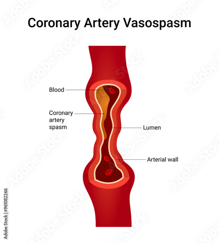 Causes of Coronary Artery Vasospasm