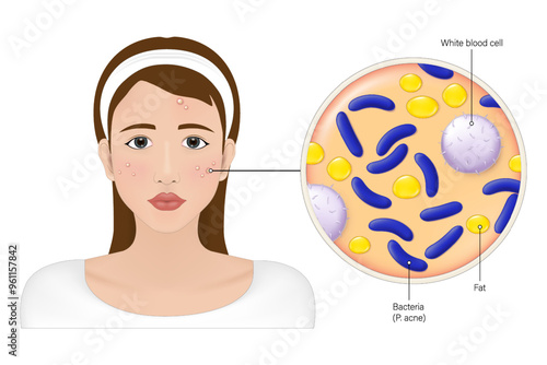 Woman with skin problem and a magnified view of the bacteria that cause acne. Vector for advertising about beauty and medical treatment. Dermatology.