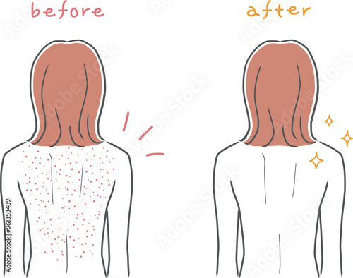 背中が肌荒れしている女性と背中がきれいな女性のイラスト素材