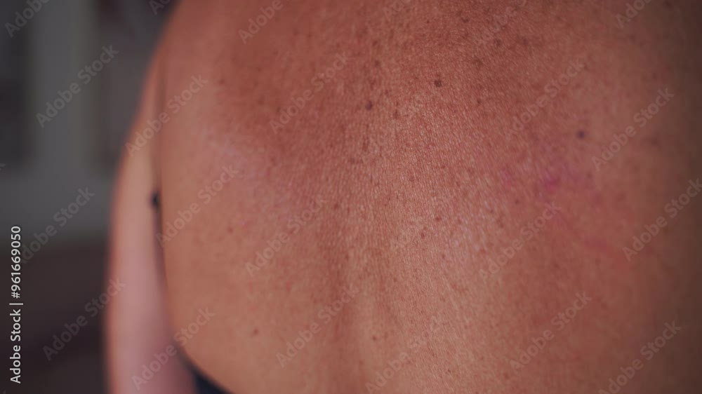 A detailed view of sunburnt skin with visible freckles, aging spots, and skin irritation on the back A detailed view of sunburnt skin with visible freckles, aging spots, and skin irritation on the back