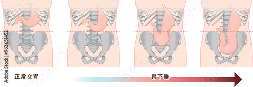 胃下垂、胃、胃アトニー、STAGE OF GASTROPTOSIS