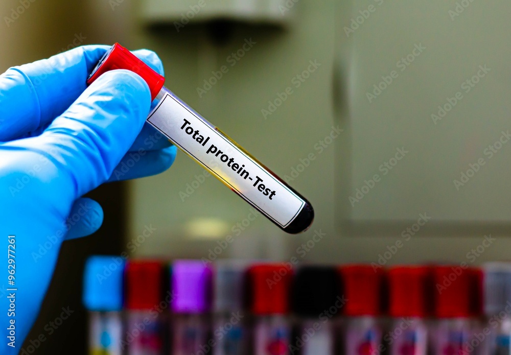 Blood sample tube for total protein test analysis. Blood sample tube for total protein test analysis.