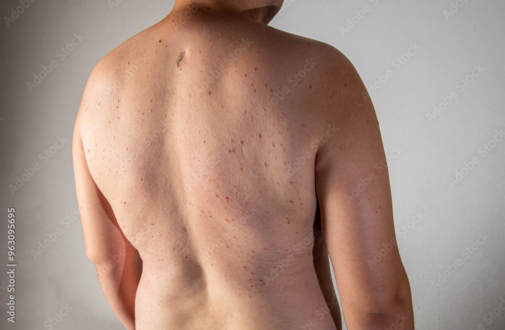 Red pimples on a man's back. Concept of inflammation of the sebaceous glands, dermatology, close-up Red pimples on a man's back. Concept of inflammation of the sebaceous glands, dermatology, close-up