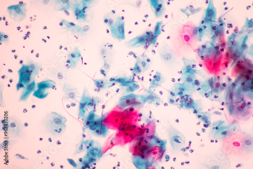 View in microscopic of Candidiasis, fungus infection (Yeast and Pseudohyphae form) in pap smear slide cytology and diagnostic by pathologist.Gynecology report and diagnosis.Sexually transmitted infect photo