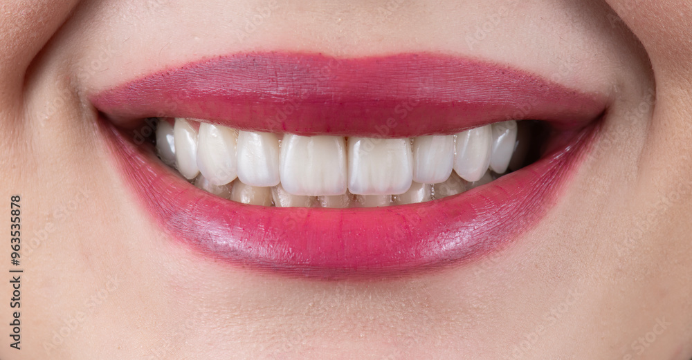 Fototapeta premium ceramic veneers b1 color