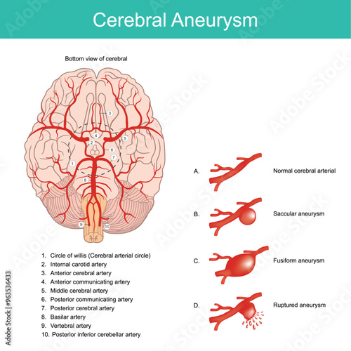 Cerebral Aneurysm. A bulging artery weakened area in the wall of an artery in the brain.the artery wall will burst and open blood fill out.