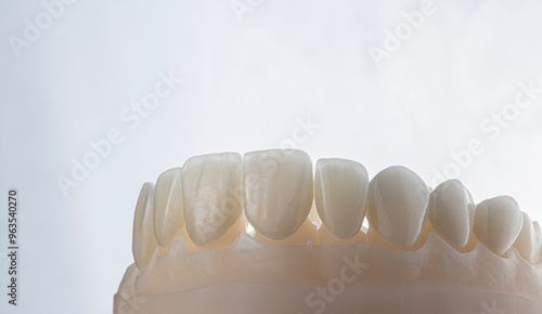ceramic veneers b1 color