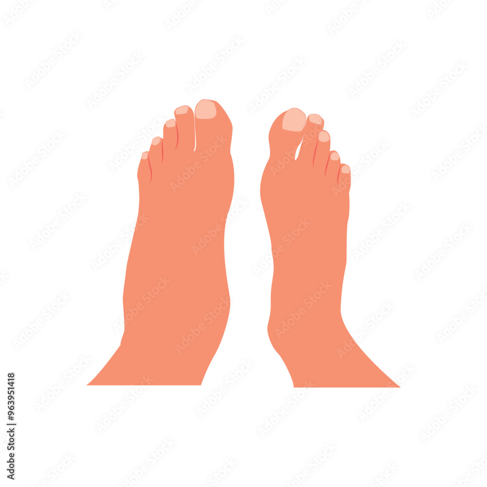 Swollen foot, normal foot. Before, after. Healthcare illustration. Vector illustration. Swollen foot, normal foot. Before, after. Healthcare illustration. Vector illustration.