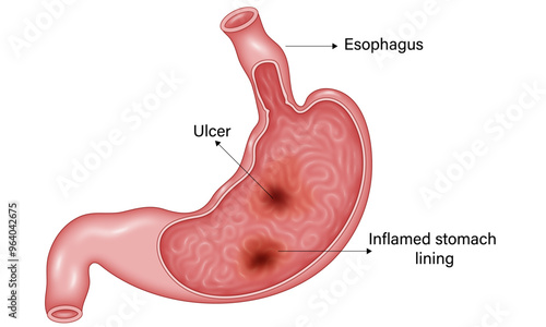 Detailed Vector Illustration of Gastritis in the Stomach: Anatomy, Symptoms, and Inflammation Stages for Educational Purposes