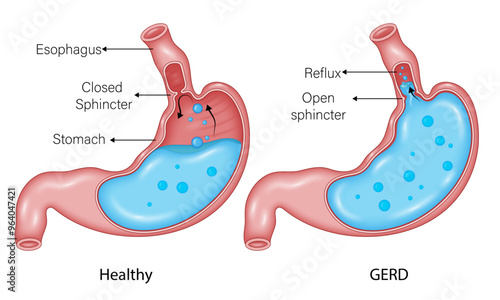 Detailed Vector Illustration of Gastroesophageal Reflux Disease (GERD) in the Stomach Compared to Normal Conditions, Highlighting Key Anatomical Differences and Pathophysiology of Acid Reflux
