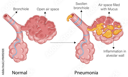 Detailed Pathology of Pneumonia: Comparing Airspace Filled with Mucus to Normal Lung Condition in a Comprehensive Illustration
