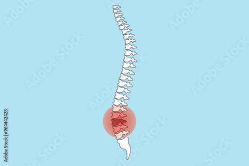 Transverse myelitis is spinal cord inflammation causing weakness, sensory loss, and paralysis.sclerosis, neuromyelitis optica, lupus, or post-infectious syndromes,pain