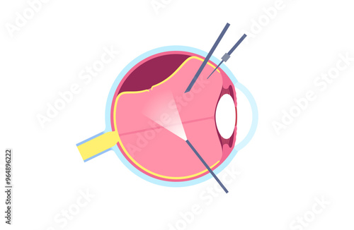 Vitrectomy surgical poster