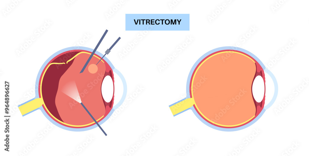 Vitrectomy surgical poster Vitrectomy surgical poster