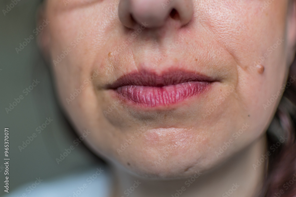 Fototapeta premium Old scar above lip on face