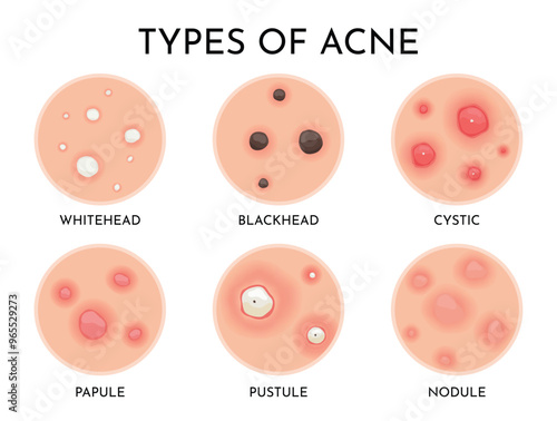 Understanding the Various Types of Acne A Comprehensive Visual Guide for Everyone
