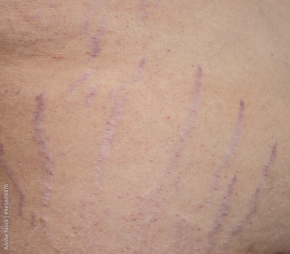 A person's skin is covered in red marks A person's skin is covered in red marks