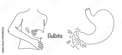Bulbitis