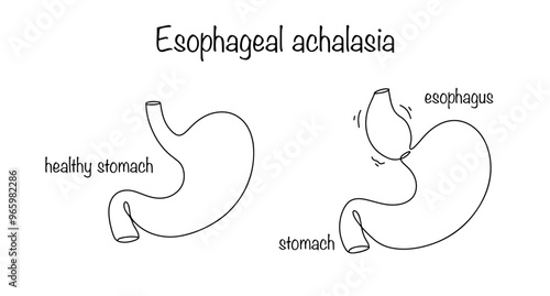Esophageal achalasia