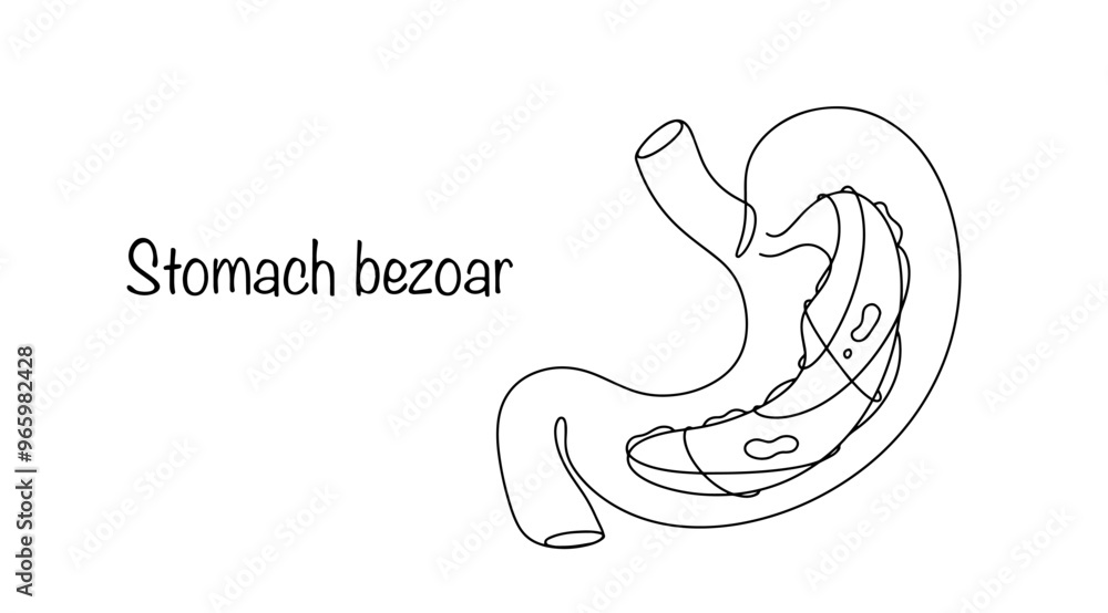 Stomach bezoar