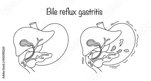Bile reflux gastritis