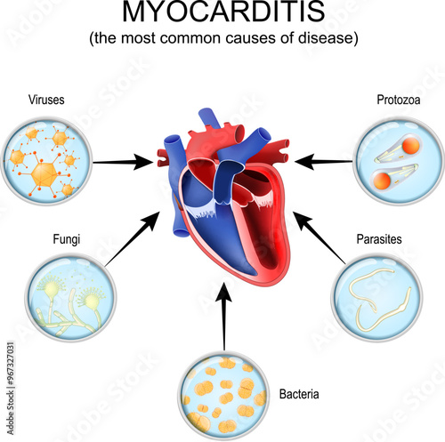 Myocarditis. Cross section of a human heart