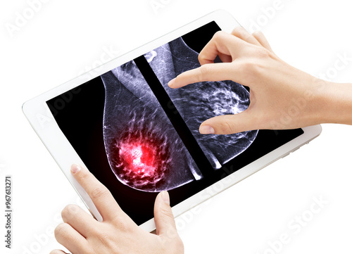 The hand gestures towards a tablet displaying detailed  of X-ray Digital Mammogram both breast  MLO view isolated on white background. Clipping path. photo