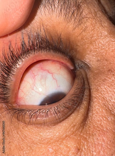 close up of eyecloseup photo of the patient eye with mild conjunctivitis photo