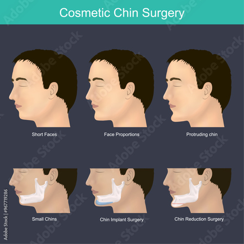 Cosmetic Chin Implant Surgery. Illustration of the chin and jaw for explain the corrected proper human face proportions.