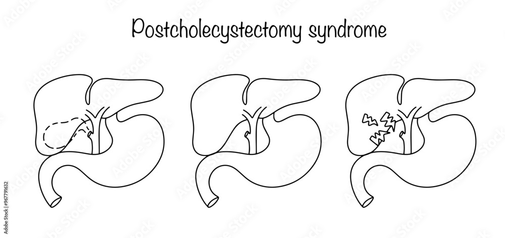 Postcholecystectomy syndrome Postcholecystectomy syndrome