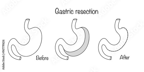 Gastric resection