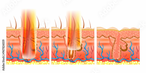 Laser hair removal. Depth of penetration by various lasers. Depth of light penetration into skin by wavelength photo