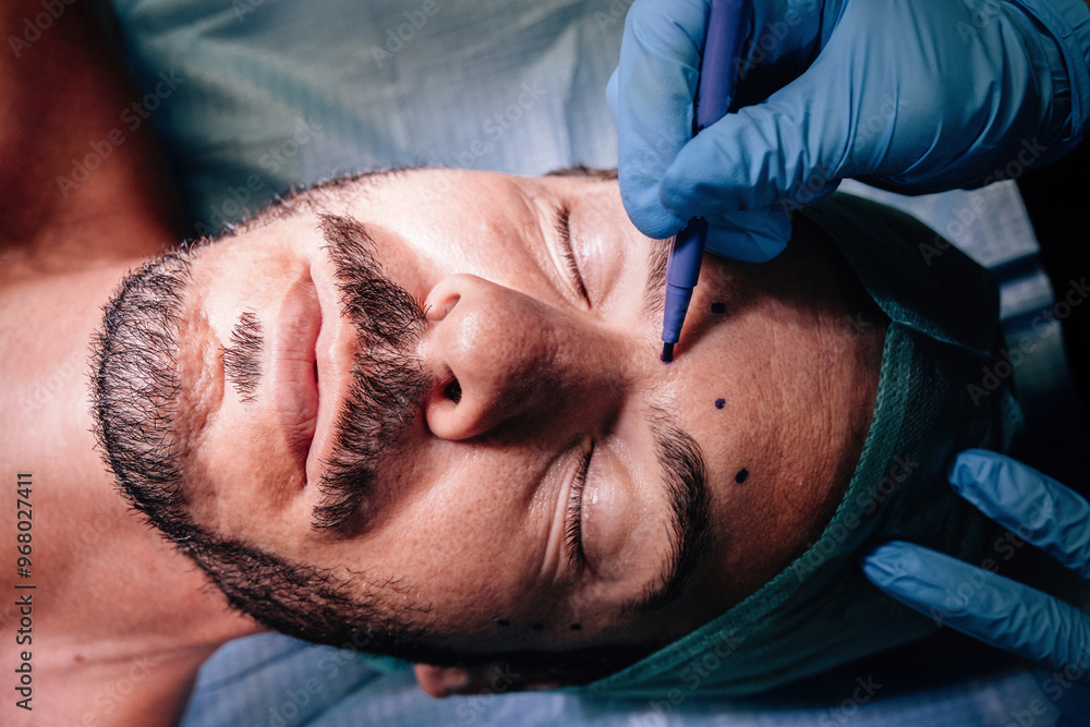 Marking the face in preparation for surgery Marking the face in preparation for surgery
